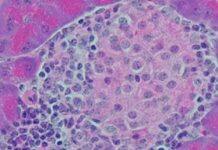 Discovery boosts hopes of preventing Type I diabetes