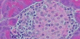 Discovery boosts hopes of preventing Type I diabetes