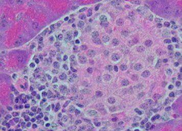 Discovery boosts hopes of preventing Type I diabetes
