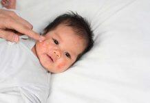 5 tips to help with eczema in babies