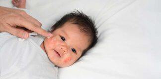 5 tips to help with eczema in babies