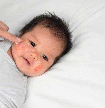 5 tips to help with eczema in babies