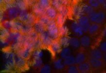 Genome sequencing reveals underdiagnosed cause of long-term lung condition