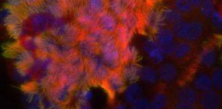 Genome sequencing reveals underdiagnosed cause of long-term lung condition