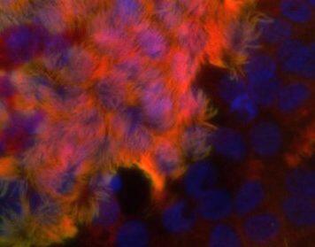 Genome sequencing reveals underdiagnosed cause of long-term lung condition