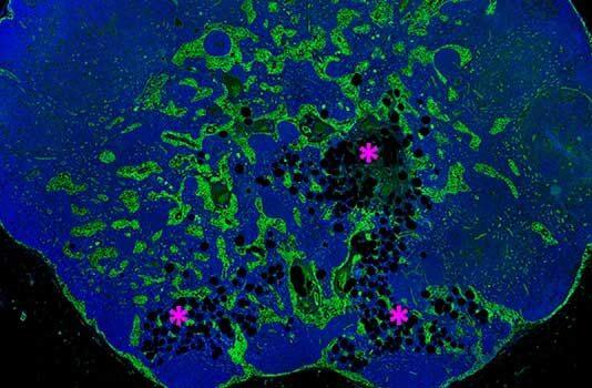 How fat takes over the lymph nodes as we age
