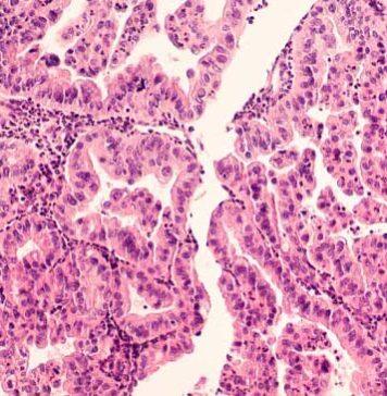 £2.2m For Glasgow Cancer Centre To Help Find New Treatments