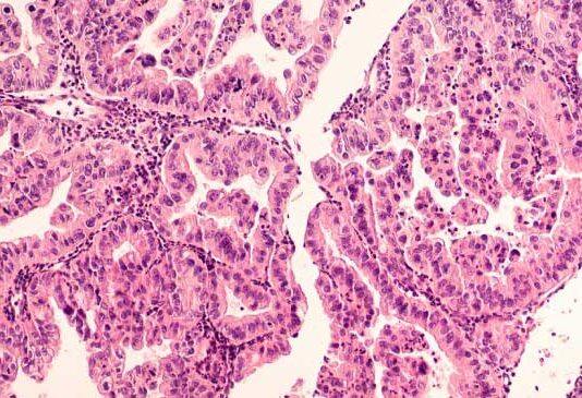 £2.2m For Glasgow Cancer Centre To Help Find New Treatments