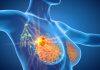 Why paraspeckles may be key to better understanding breast cancer