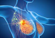 Why paraspeckles may be key to better understanding breast cancer