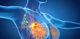 Why paraspeckles may be key to better understanding breast cancer