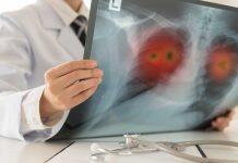 Lung cancer and mesothelioma research receives funding boost