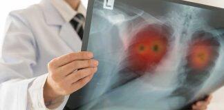Lung cancer and mesothelioma research receives funding boost