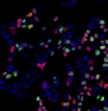 Androgen study could lead to new treatments for breast cancer