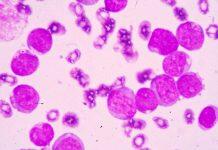 New therapy could help chronic myeloid leukemia patients live drug-free