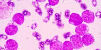 New therapy could help chronic myeloid leukemia patients live drug-free