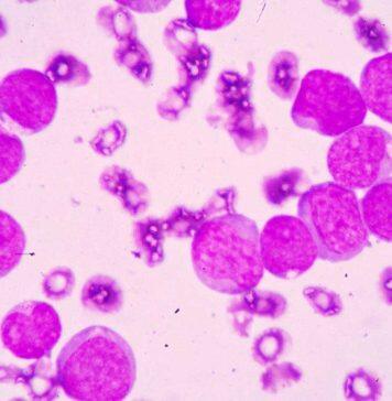 New therapy could help chronic myeloid leukemia patients live drug-free
