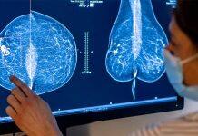 Discovery of new gene mutation could play a role in breast cancer prevention: Study