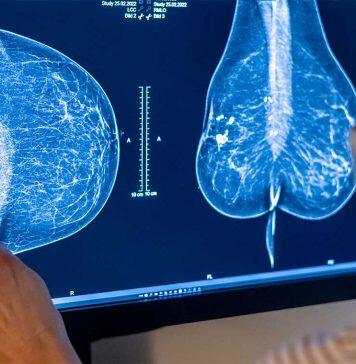 Discovery of new gene mutation could play a role in breast cancer prevention: Study