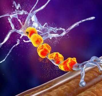 Motor neuron disease treatments a step closer