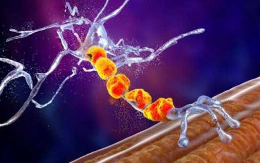 Motor neuron disease treatments a step closer