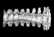 Western research sheds light on symptoms of understudied spine disease
