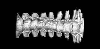 Western research sheds light on symptoms of understudied spine disease