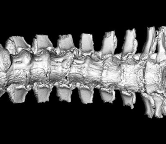 Western research sheds light on symptoms of understudied spine disease
