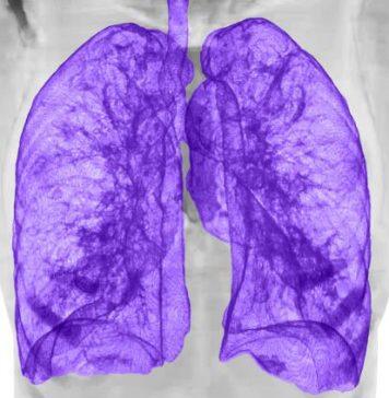 New MRI scanning technology to improve clinical accessibility and advance lung disease diagnosis