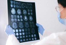 Cannabinoid-based drug trial for brain tumours begins