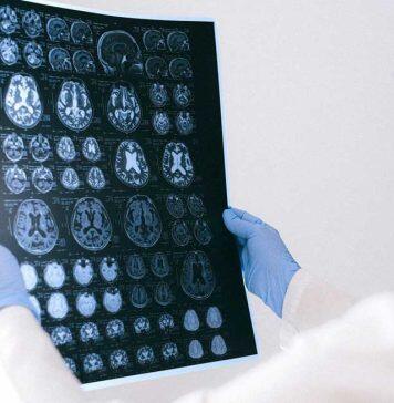 Cannabinoid-based drug trial for brain tumours begins
