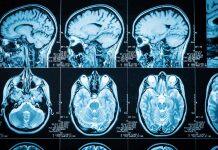 Global collaboration to tackle dementia care