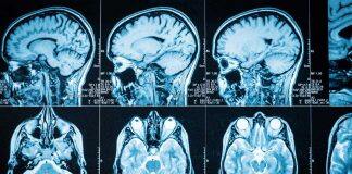 Global collaboration to tackle dementia care