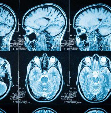 Global collaboration to tackle dementia care