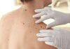 Potential genetic screening for aggressive melanoma