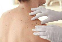 Potential genetic screening for aggressive melanoma