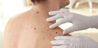 Potential genetic screening for aggressive melanoma