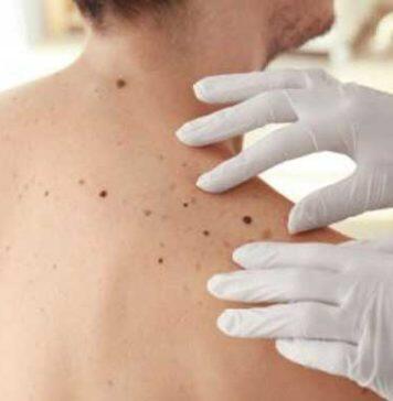 Potential genetic screening for aggressive melanoma