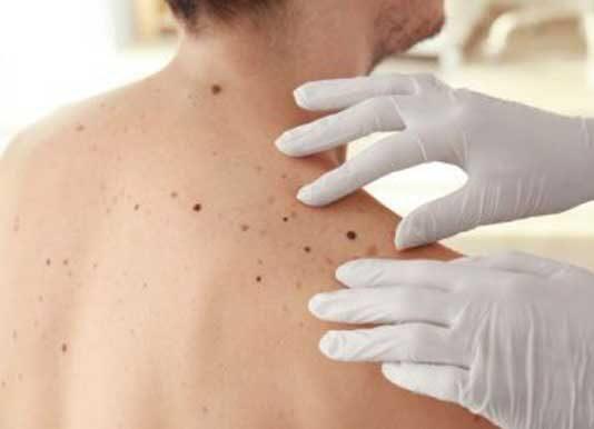 Potential genetic screening for aggressive melanoma