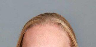 Rapid rise of endometrial cancer in Aotearoa