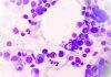 New therapy target to shut down multiple myeloma’s ability to survive and thrive
