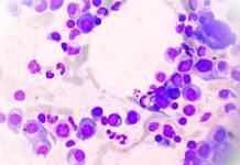 New therapy target to shut down multiple myeloma’s ability to survive and thrive