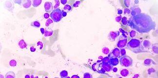 New therapy target to shut down multiple myeloma’s ability to survive and thrive