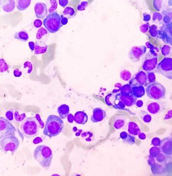 New therapy target to shut down multiple myeloma’s ability to survive and thrive