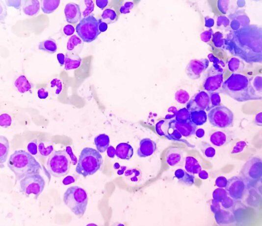 New therapy target to shut down multiple myeloma’s ability to survive and thrive