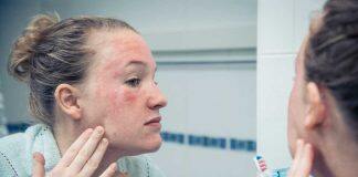 People with eczema needed to help with bathing study