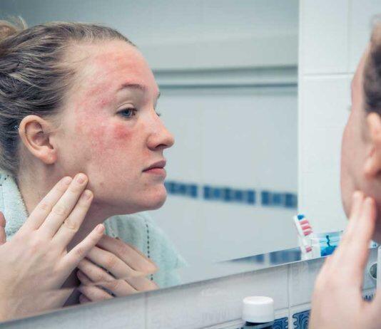 People with eczema needed to help with bathing study
