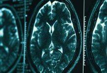 Study reveals longer term impact of sport-related brain injuries