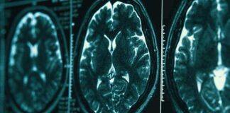 Study reveals longer term impact of sport-related brain injuries