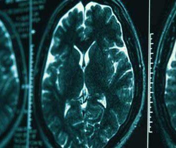 Study reveals longer term impact of sport-related brain injuries